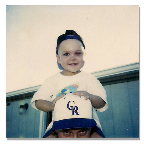 Photo Brock Walquist with his eye sewn shut.